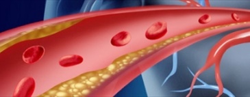 QT e ischemia miocardica